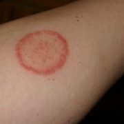 Herpès circiné