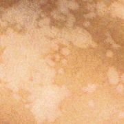 pityriasis versicolor